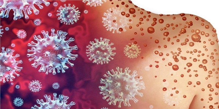 Türkiye'de Maymun çiçeği alarmı: Karantina ve Sağlık açıklamaları